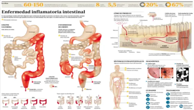 Enfermedad inflamatoria intestinal EII