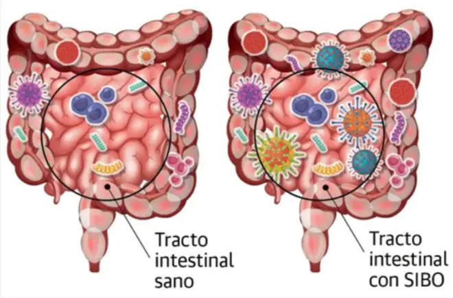 tractos intestinales SBO