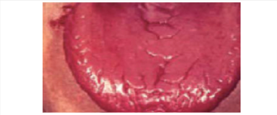 Lengua con vacío de riñon